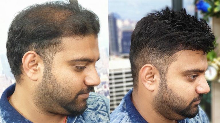 Start Now! Explore Non-Surgical Hair Replacement for Men