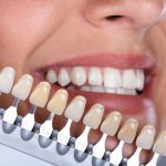 Composite Bonding: Elevating Dental Function with Aesthetic Precision