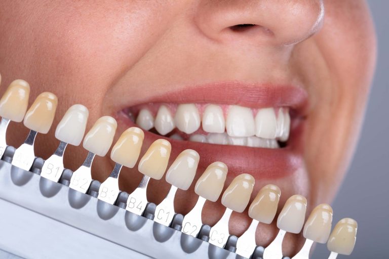 Composite Bonding: Elevating Dental Function with Aesthetic Precision